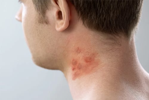 Contact-Dermatitis